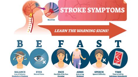 Fewer Strokes Raise Red Flags At Local Emergency Department