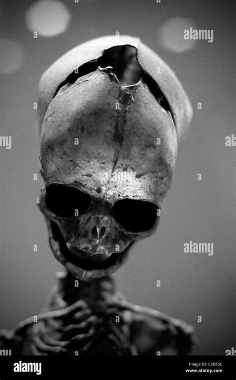 Deformed skull Stock Photo: 36554152 - Alamy