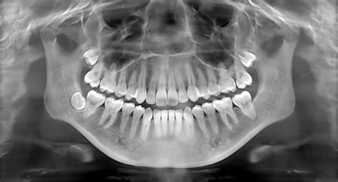 Dental X-Rays, Do I Really Need Them? - Clinique DMD