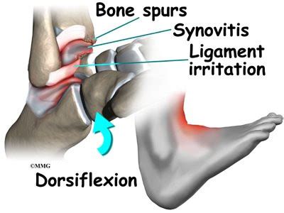 Ankle Impingement | eOrthopod.com