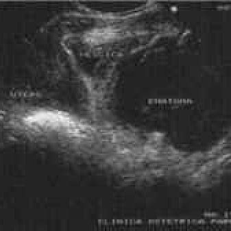 (PDF) Retzius' space haematoma after spontaneous delivery: A case report