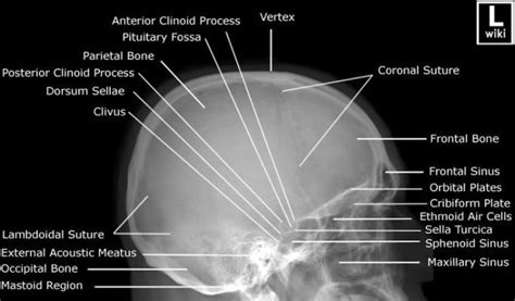 Radiographic Anatomy - Skull Lateral | Radiology imaging, Medical radiography, Radiology