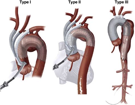 Association between Aortic Remodeling and Stent Graft-Induced New Entry in Extensive Residual ...