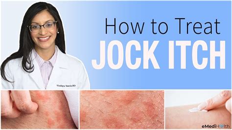 Jock Itch Treatment, Prevention, Causes, and Home Care Tips - YouTube
