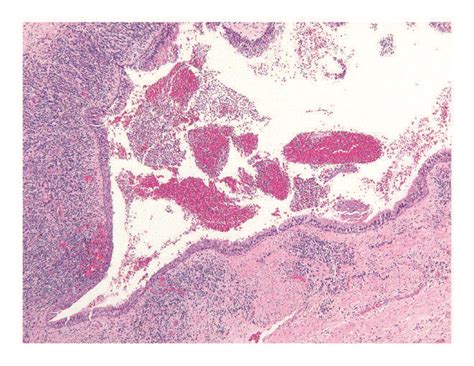 Residual Cyst Histology