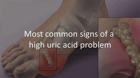 High Uric Acid Symptoms : Pin on Uric acid : A high concentration of uric acid in the blood ...