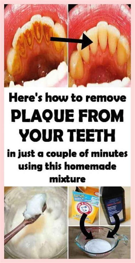 Remove Plaque From Your Teeth Just In 2 Minutes! | Homemade mouthwash ...