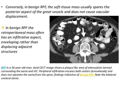 Retroperitoneal Fibrosis