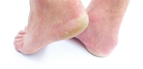 Foot callus? Foot Corn? Foot wart?: Ankle & Foot Centers of Georgia ...