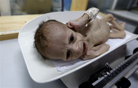 Yemen's Children Are Starving To Death - BuzzFeed News