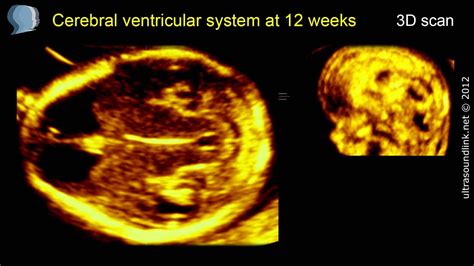 Fetal brain at 12 weeks: Cerebral ventricles 3D ultrasound - YouTube