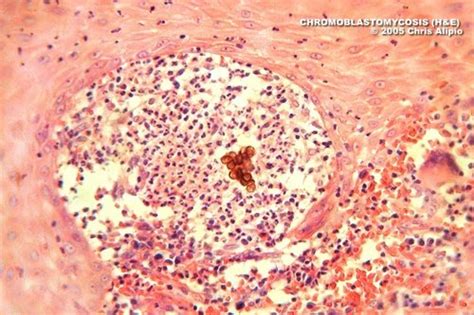 Chromoblastomycosis; Chromomycosis; Dermatitis Verrucosa