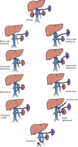 Anatomy of the Portal System and Experience with Portacaval Shunt ...