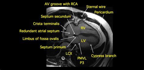 MRI BLOG: Cardiac Anatomy