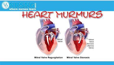 Heart Murmurs | Aortic/Mitral Stenosis, Regurgitation | How to identify | Heart murmur, Heart ...