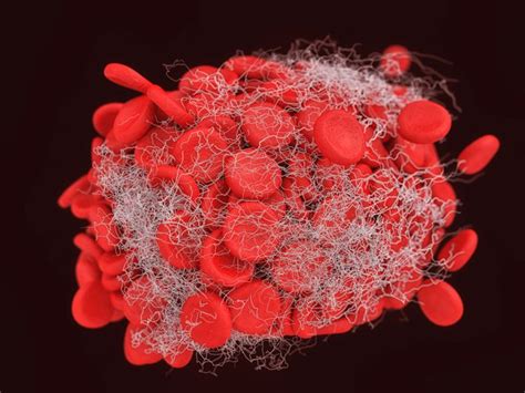 The Difference Between Embolus and Thrombus