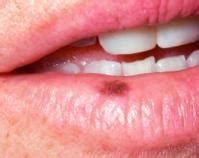 Dark Spots on Lips Causes, How to Get Rid of, Remove, Treat Brown Black Spot Around Upper ...