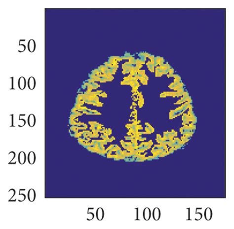 Fully automatic gray and white matter segmentation in brain MRI images... | Download Scientific ...