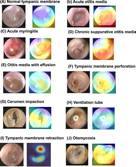 Acute Otitis Media Tympanic Membrane