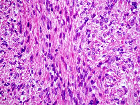 Leiomyosarcoma - Causes, Symptoms, Survival Rate, Treatment