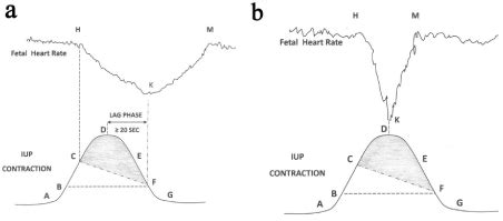 Myths at the core of Intrapartum Cardiotocography Interpretation – Risks of false Ideology ...