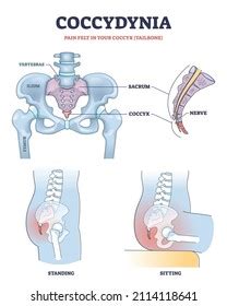 4,285 Coccyx pain Images, Stock Photos & Vectors | Shutterstock