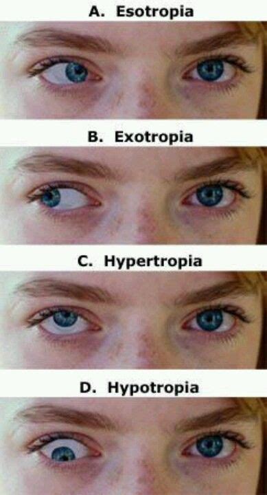 Strabismus or Crossed Eyes | Medical knowledge, Vision therapy, Medical ...