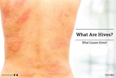 What Are Hives? What Causes Hives? - By Dr. Deepshikha Parihar | Lybrate