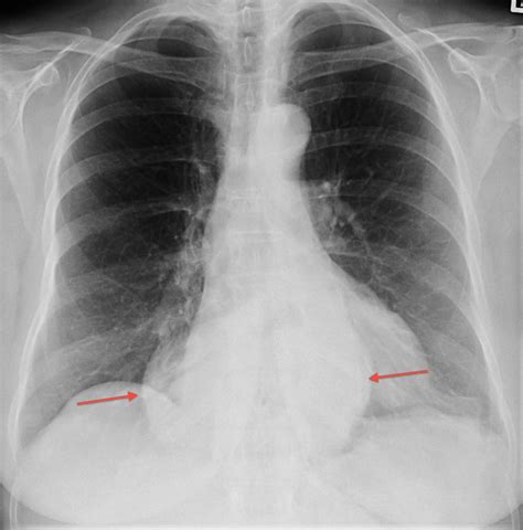 Hiatus hernia - Radiology at St. Vincent's University Hospital