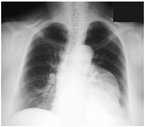 Teratoma | Thoracic Key