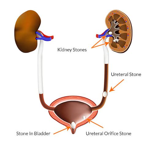 Kidney Stone Overview, Symptoms, Diagnosis & Treatment Options