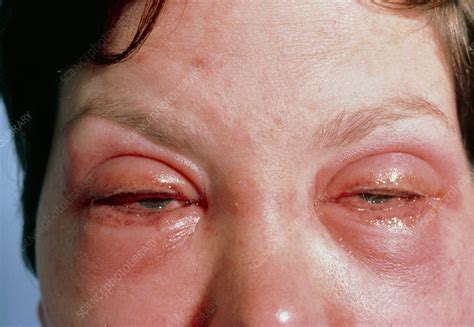 Woman's eyes inflamed due to make-up allergy - Stock Image - M320/0137 - Science Photo Library