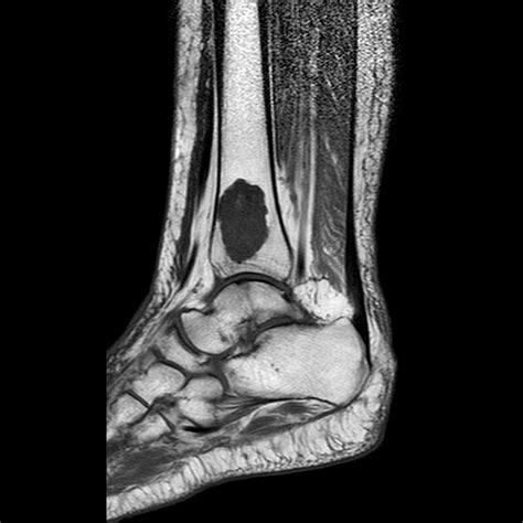 Enchondroma | Radiology Case | Radiopaedia.org | Radiology, Diagnostic imaging, Radiology student