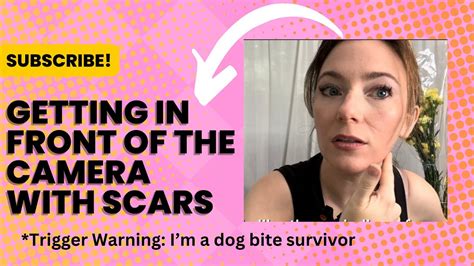 Getting in front of the camera with scars as a dog bite survivor: my ...