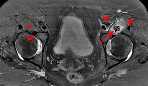 Iliopsoas Tendinopathy - Radsource