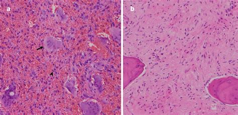 Histopathology of central giant cell granuloma lesion prior to... | Download Scientific Diagram