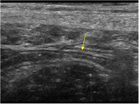 Abdomen and retroperitoneum | 1.5 Appendix : Case 1.5.1 Normal appendix | Ultrasound Cases