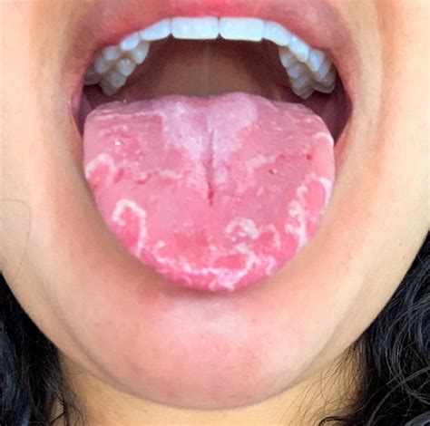 My geographic tongue during allergy season : r/mildlyinteresting