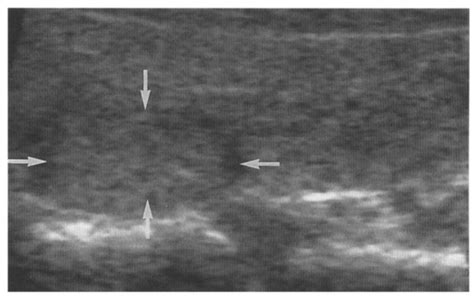 Ultrasound of the thyroid (longitudinal) showing an isoechoic nodule ...