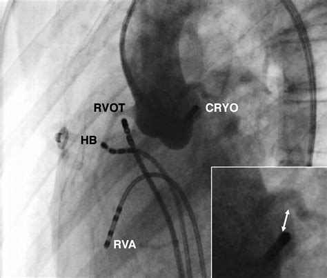 Cryoablation of a left coronary cusp ventricular tachycardia | Heart