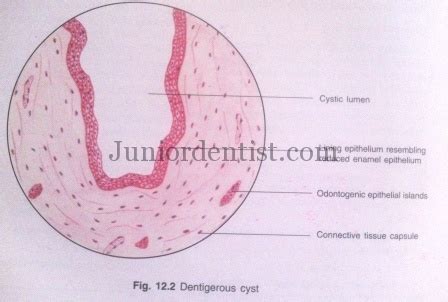 Histologic or Microscopic Features of Dentigerous Cyst | Follicular Cyst