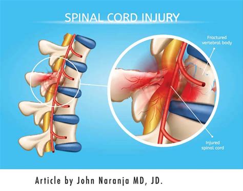 Ask Dr John, Esq - Spinal Cord Injury and Types of Paralysis - Diller Law Personal Injury Law