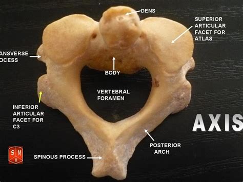 Odontoid Fractures - Physiopedia