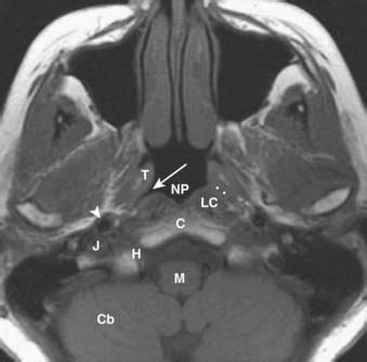 Torus Tubarius Mri