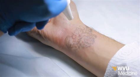 Picosure Laser Tattoo Removal Near Me: The Ultimate Guide - TattooQuestions.com