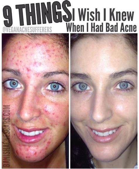 10 Things I Wish I Knew When I Had Bad Acne | Bad acne, Teenage acne ...