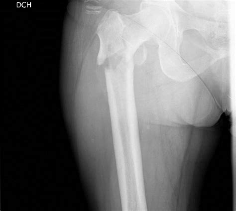 Patología Traumatologíca IVSS Lara: Fractura de Femur III