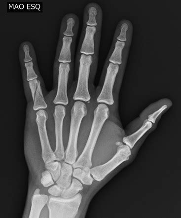 Thumb Proximal Phalanx Fracture