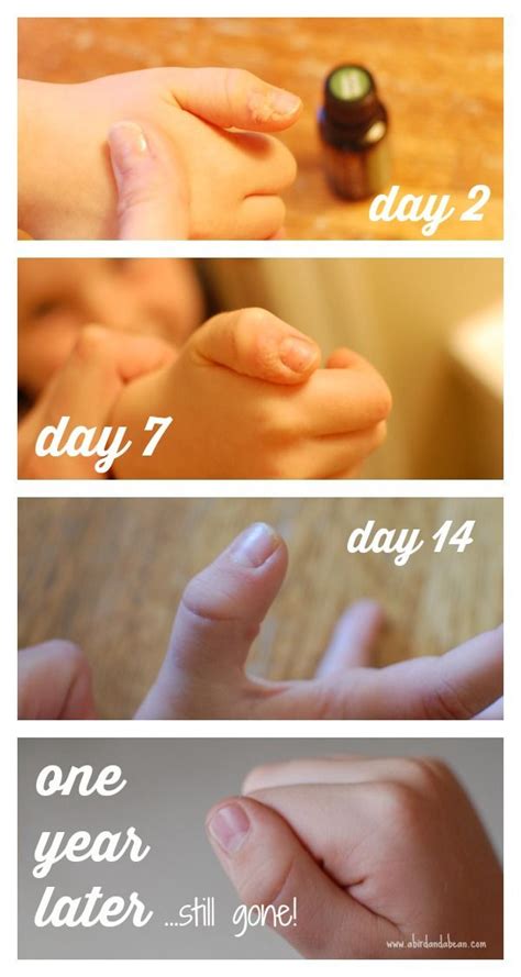 Natural, Effective Wart Removal - in just 7 days you can remove warts and keep them off without ...