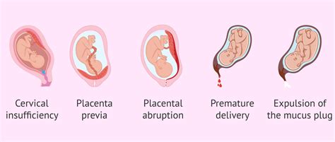 Is It Normal To Have Light Bleeding In Early Pregnancy ...